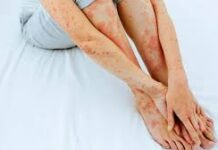 Psoríase: não se pega, mas o estresse pode desencadear