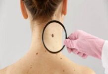 Câncer: estudo alerta para riscos de melanoma fora da pele